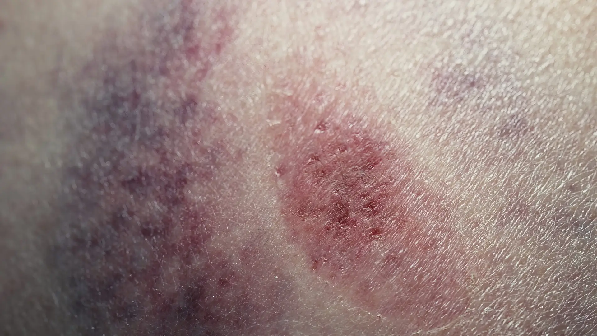 Haematology