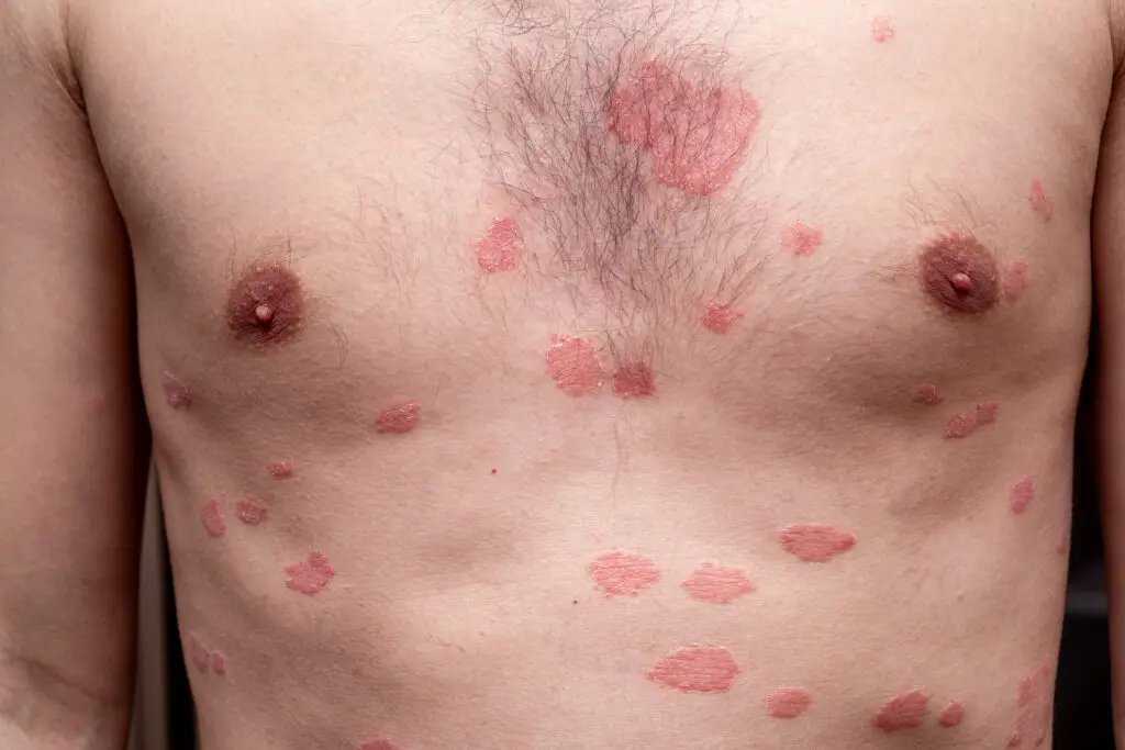 psoriasis vulgaris skin patches are typically red 2025 03 08 05 11 01 utc